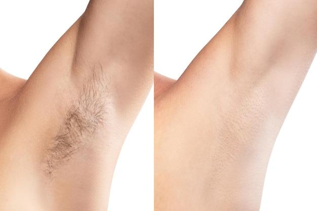 ipl vs opt hair removal