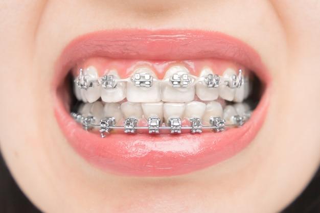 metal self ligating braces