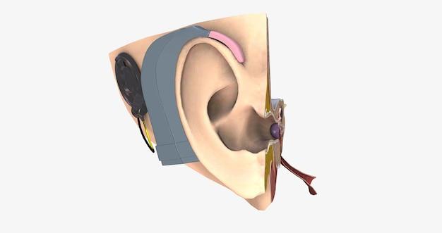 cochlear implant not working