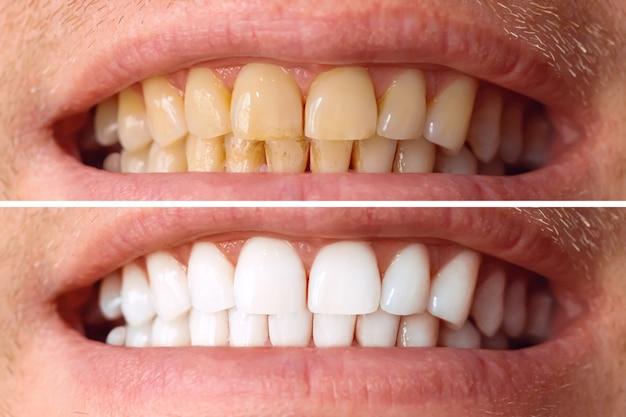 10 week invisalign treatment