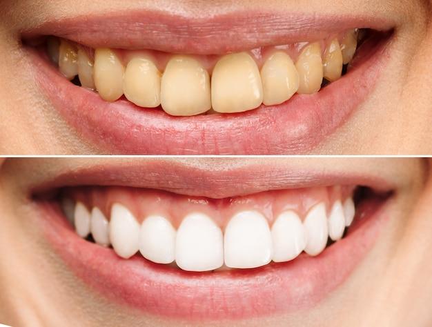 10 week invisalign treatment