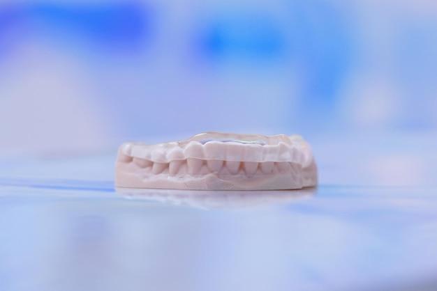 14 trays invisalign