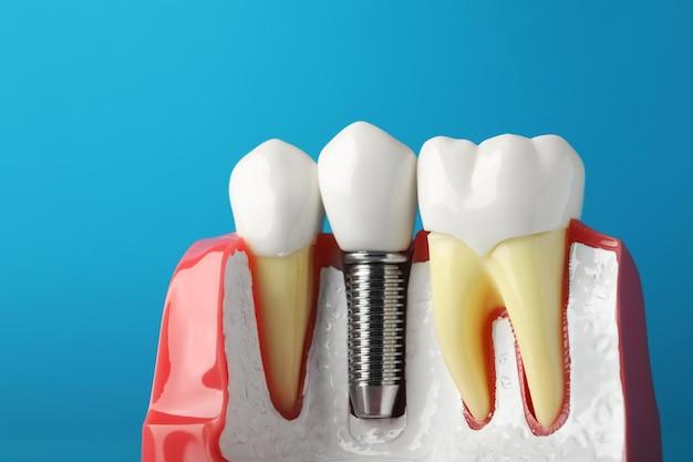 $2000 dental implants