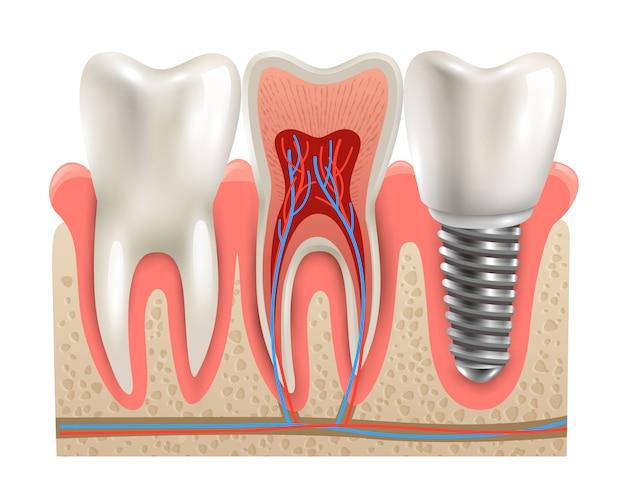 $2000 dental implants