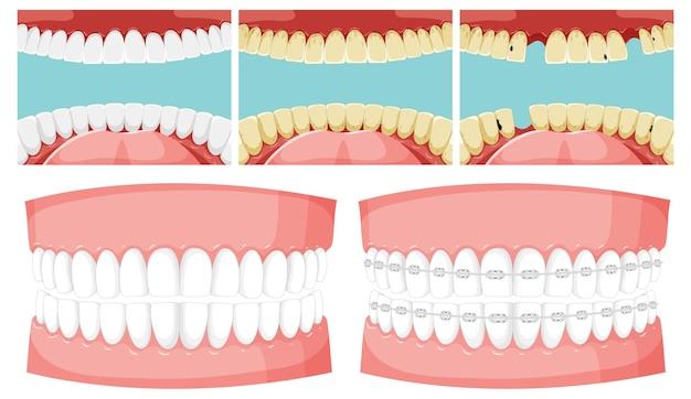 6 months invisalign