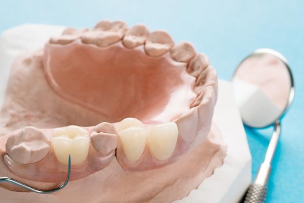 are partial dentures worth it