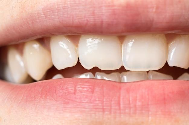 can orthodontist fix chipped tooth