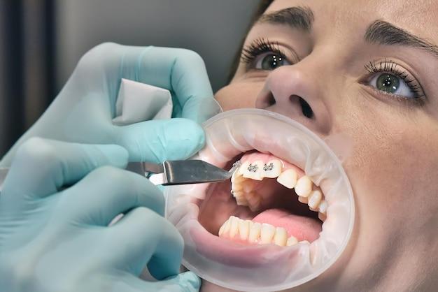 can orthodontist fix chipped tooth