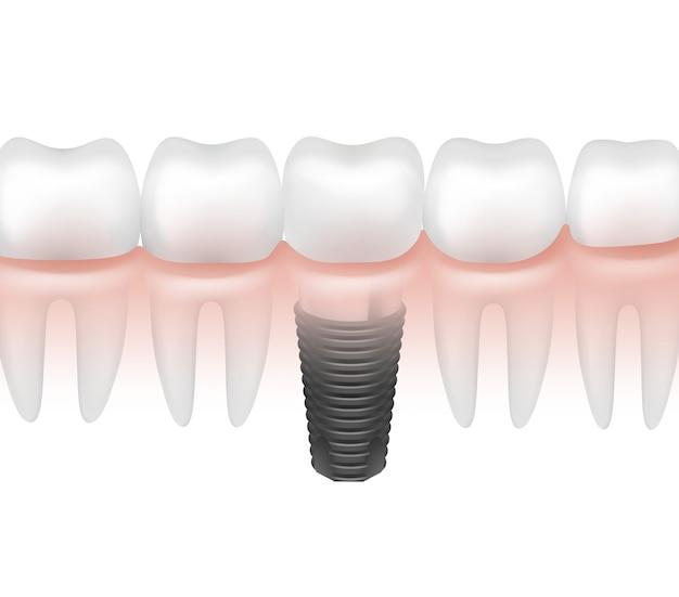 can 1 implant replace 2 teeth