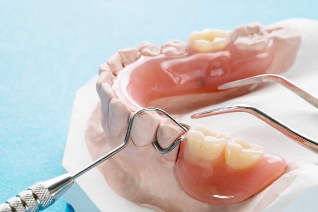 getting partial dentures