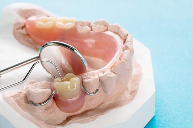 getting partial dentures