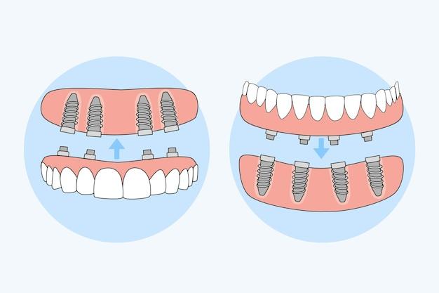 all on 4 dental implants cost california