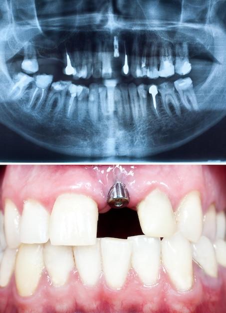 dental implant without crown