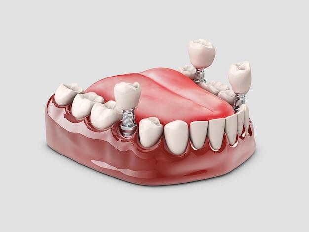 dental implants mn cost