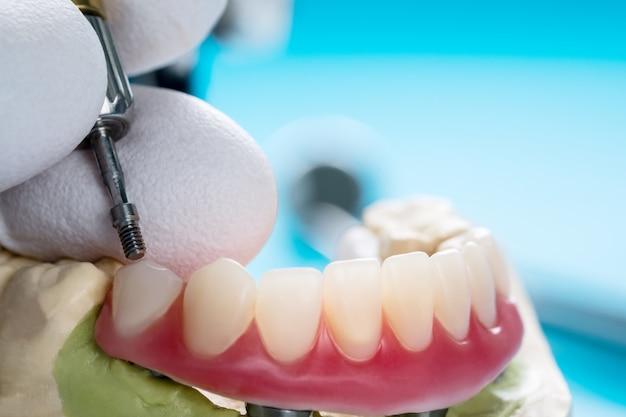 dental implants mn cost