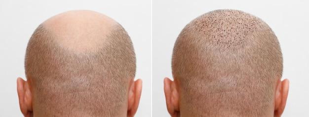 hair transplant cost nashville