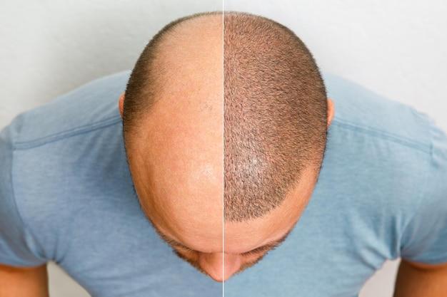 hair transplant cost nashville