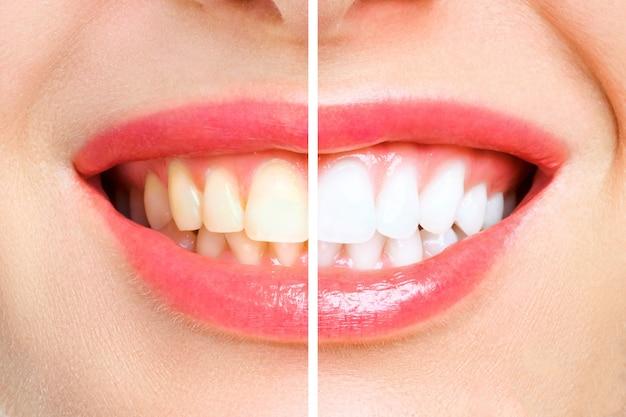 how much does invisalign cost for top teeth only