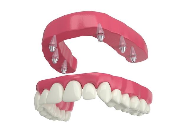 how much does invisalign cost for top teeth only