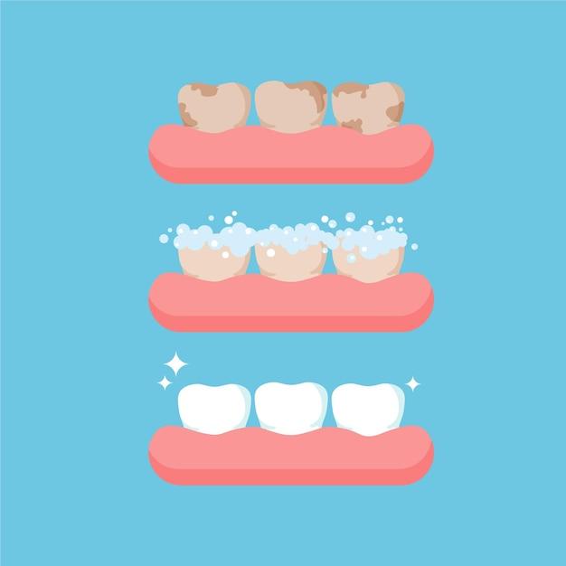 invisalign for minor corrections