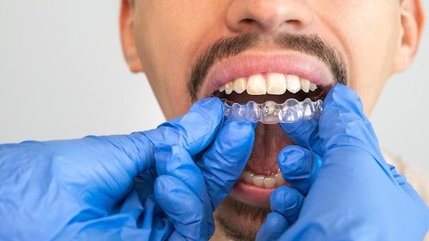 invisalign for minor corrections