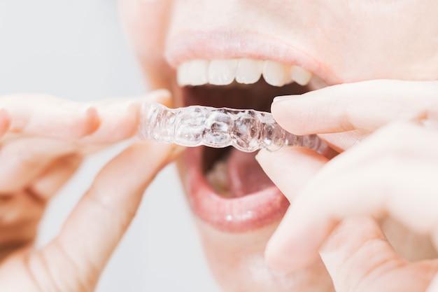 invisalign light