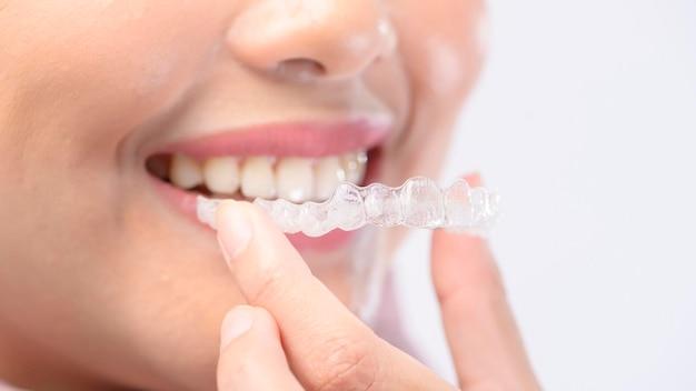 invisalign light