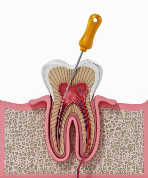 root canal laser treatment cost