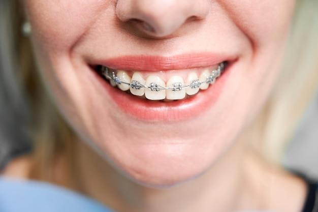 short term braces for adults