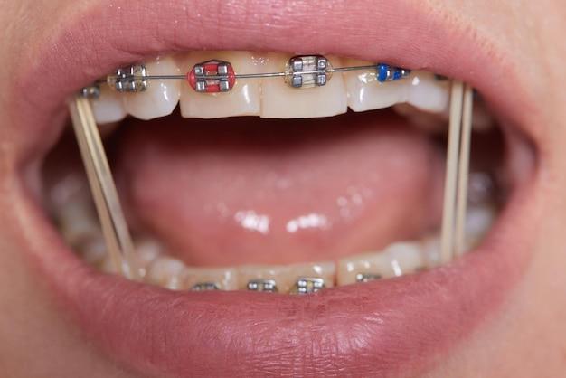 short term braces for adults