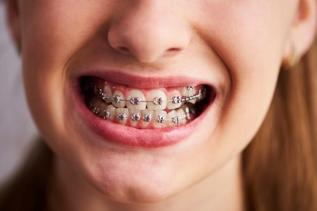 short term braces for adults