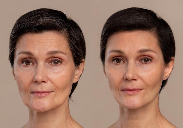 soft facelift