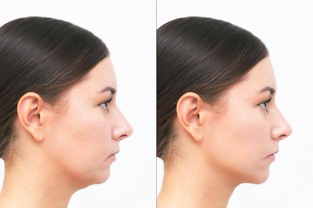 soft facelift