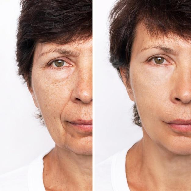 soft facelift