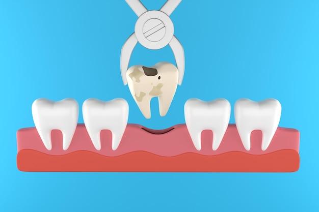 tooth extraction malpractice