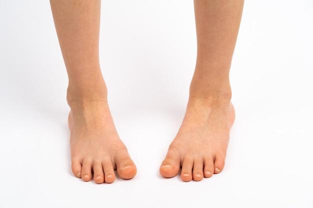 What Does Sticky Feet Mean? Understanding the Adhesive Foot and Toe ...