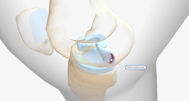 radial meniscus tear