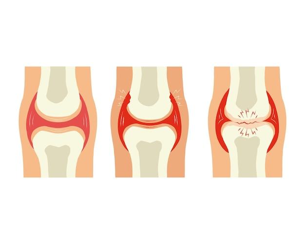 radial meniscus tear