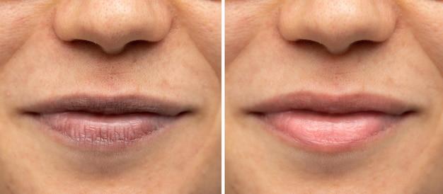 lip filler for aging lips