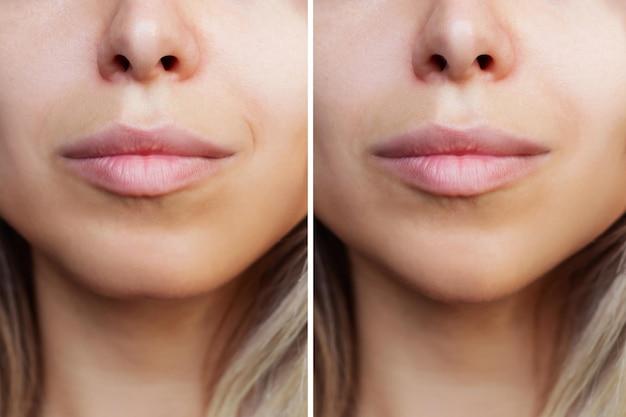 lip filler for aging lips