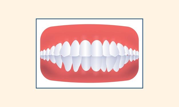 overbite vs normal