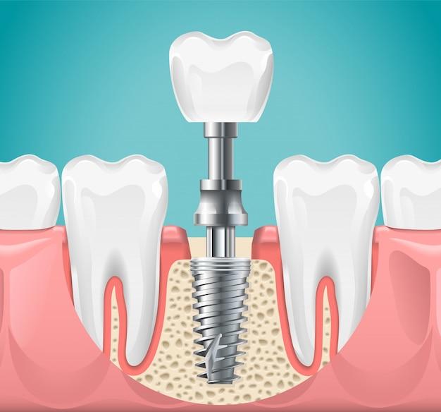 why are tooth implants so expensive