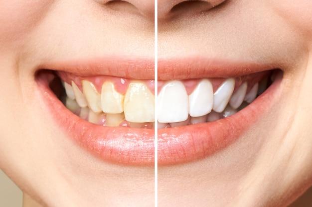  Can Teeth Be Whitened If Enamel Is Gone 