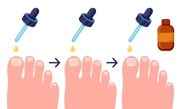  Can You Put Drawing Salve On An Ingrown Toenail 