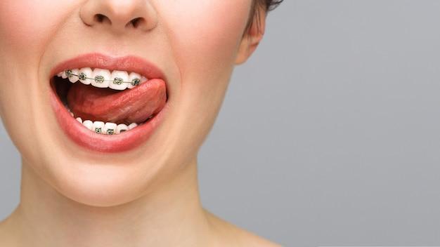  Can You Switch Metal To Ceramic Braces 