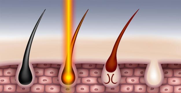  How Strong Does A Laser Have To Be To Burn 