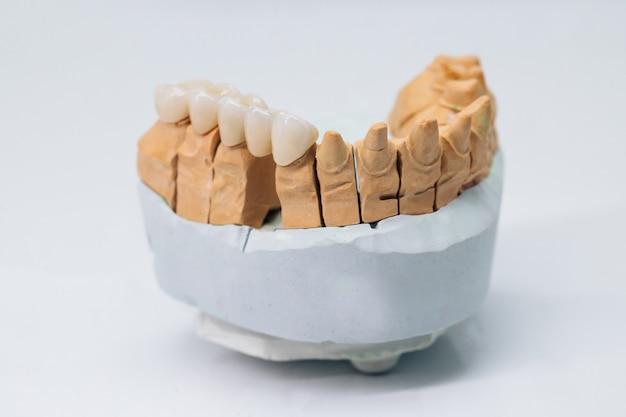  How To Etch Ceramic Crowns 